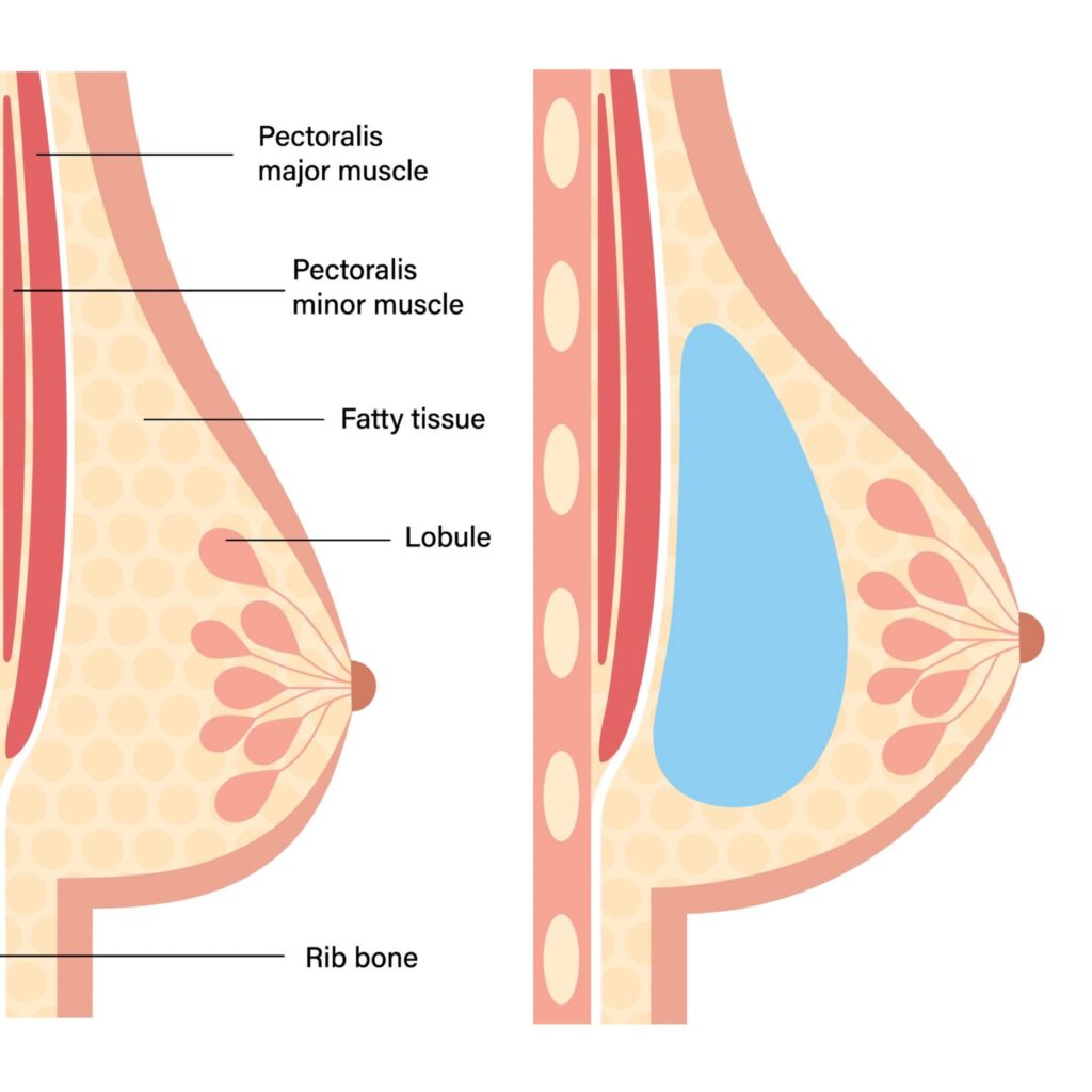 Subglandular Positioning Breast Augmentation Surgery