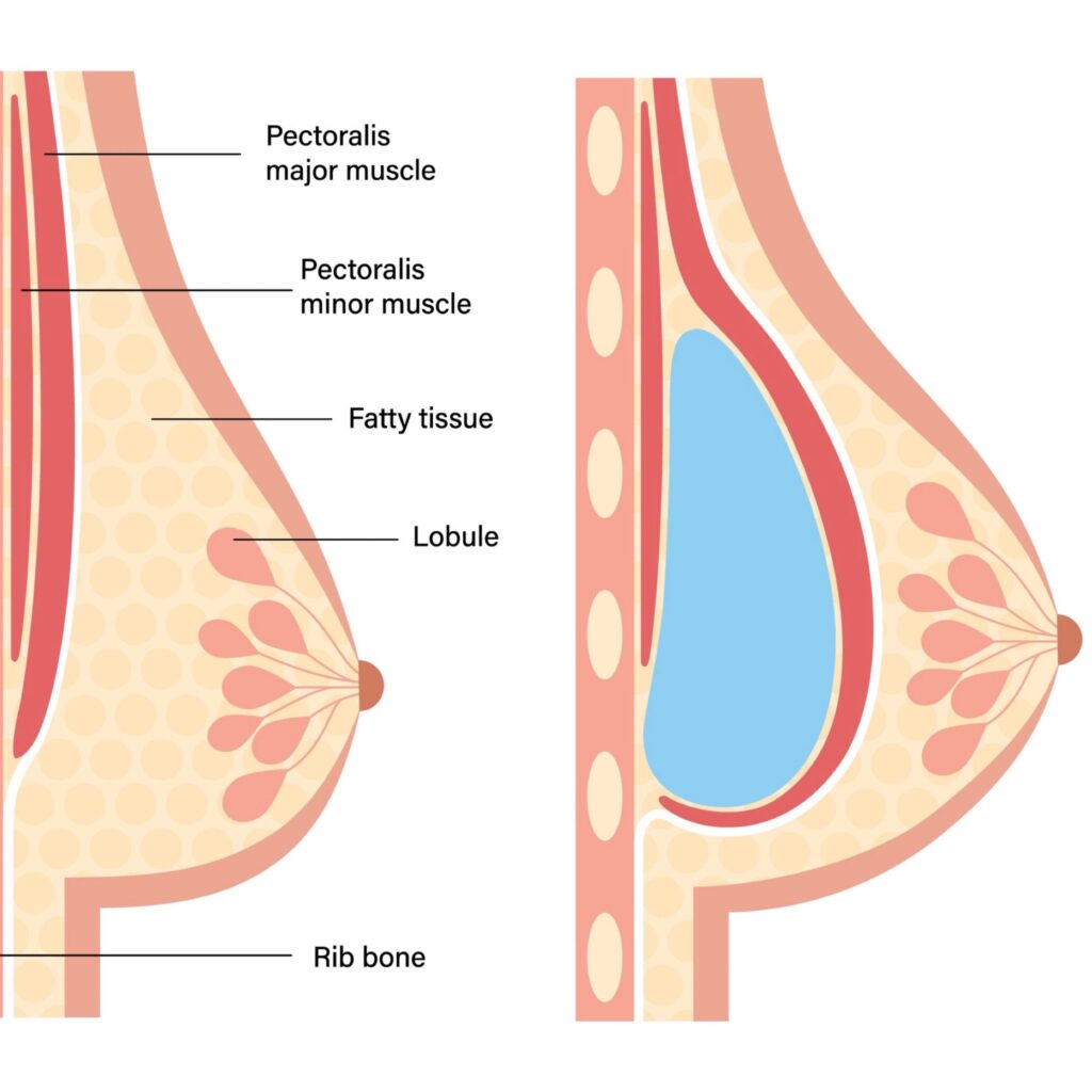 Submuscular Positioning Breast Augmentation Surgery