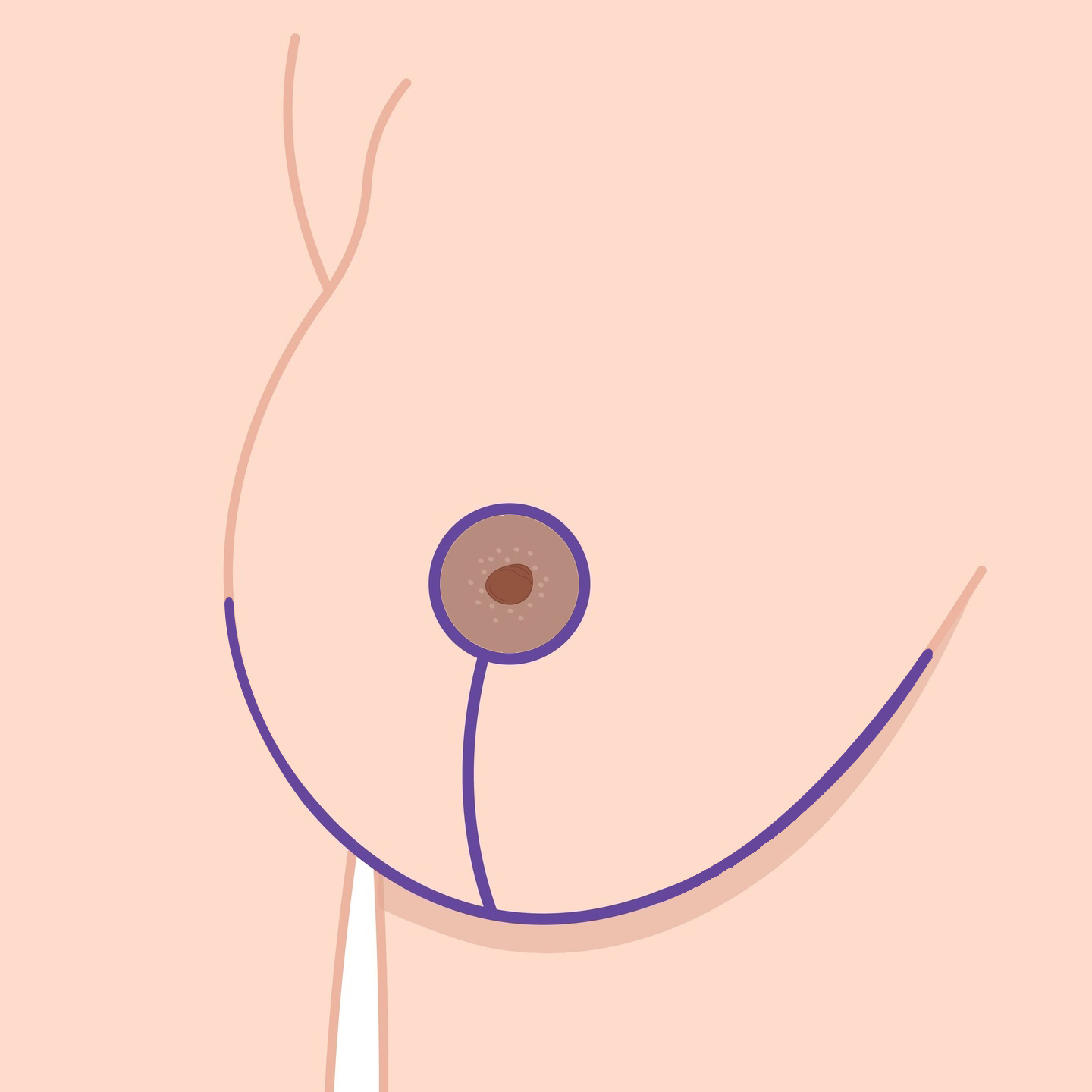 Anchor shape mastopexy surgery incision Anchor shape mastopexy surgery incision