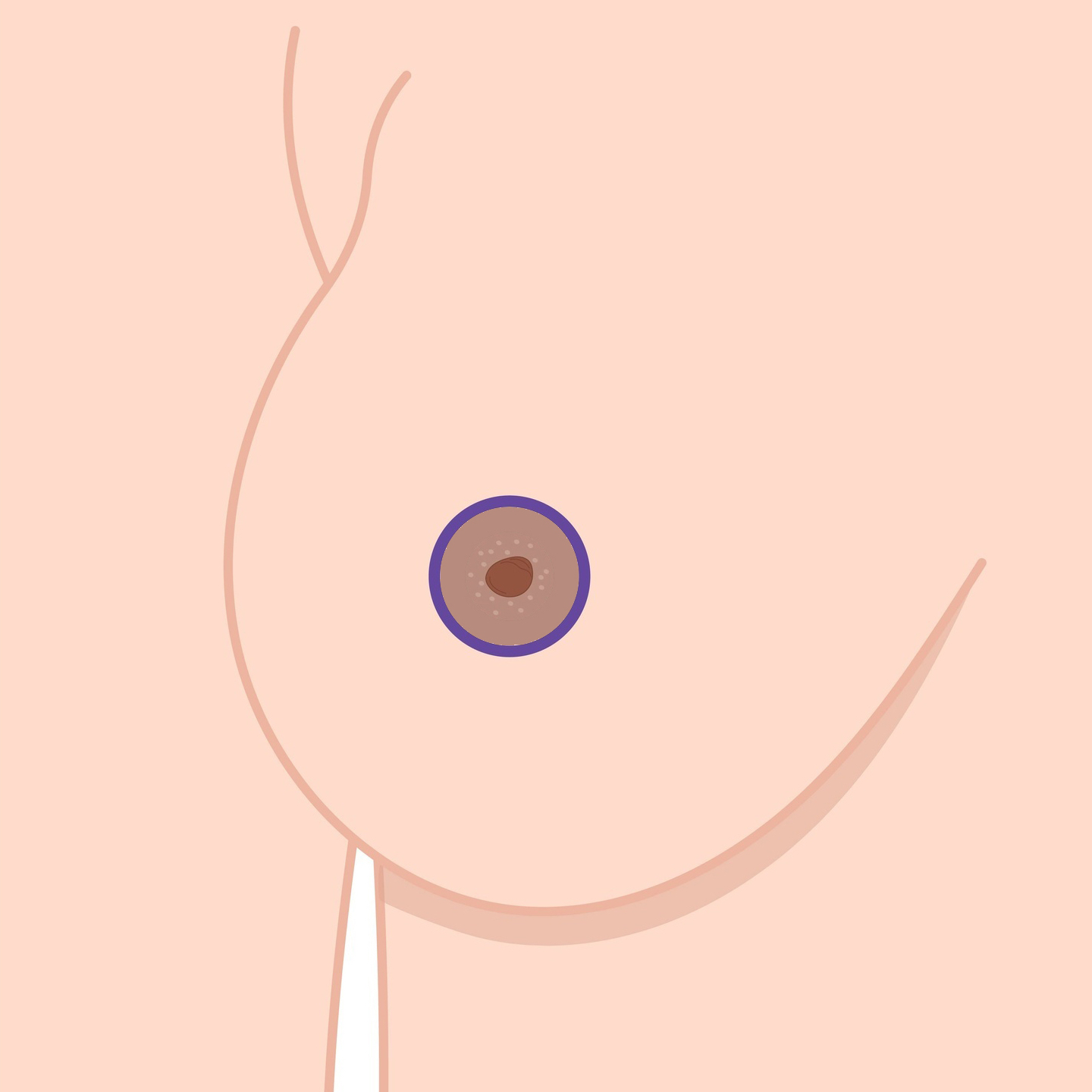 Circum areola mastopexy surgery incisions Circum areola mastopexy surgery incisions