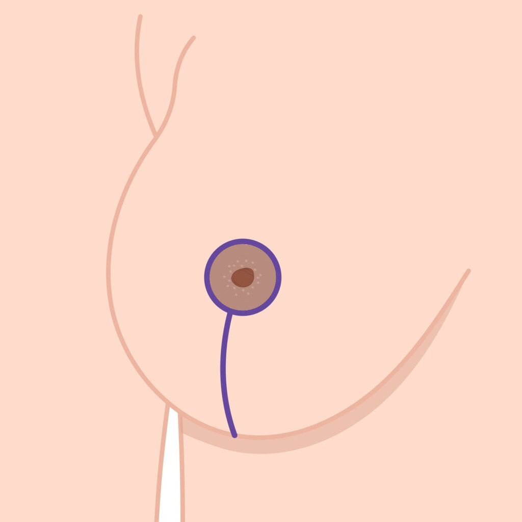 Vertical mastopexy surgery lolipop incision