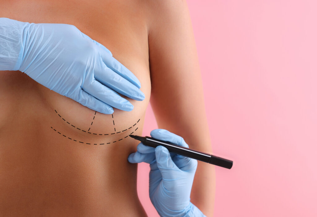 Image of gloved hands holding marker to a woman's breast to prepare for surgery.