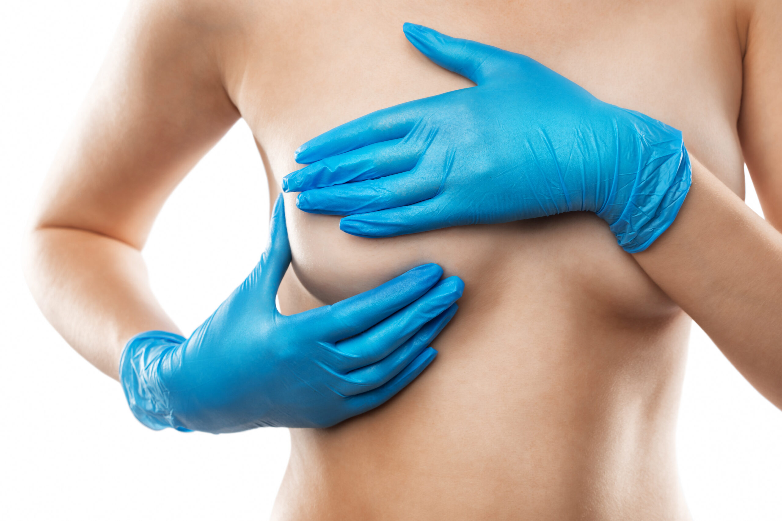 Breast Asymmetry