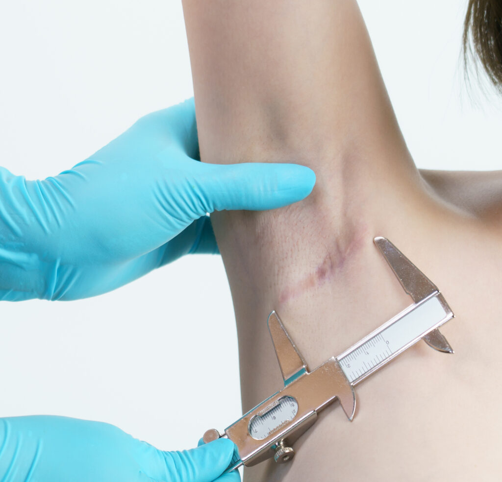 A doctor checking the size of a boob job scar.