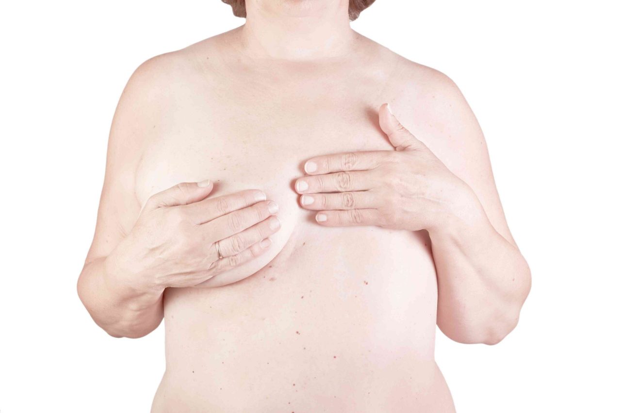 Mastectomy Breast surgery in Newcastle